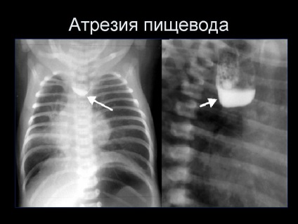 Boli ale esofagului și ale tractului gastro-intestinal - atrezia și aplasia esofagului, tratamentul la Moscova