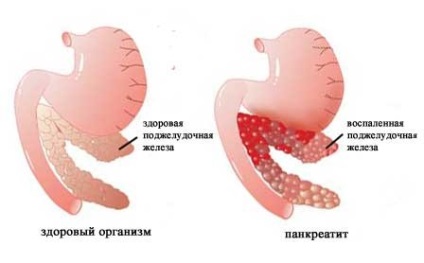 Boli ale pancreasului și tratamentul medicamentelor folclorice ale pancreasului