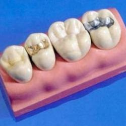 Plăcile dentare care sunt diferențele, smilie-clinica g