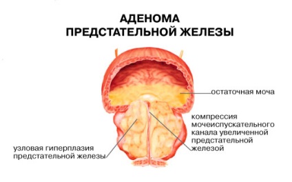 Hiperplazia adenomatoasă