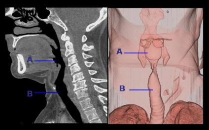 Afoniya - aceasta este cauza, diagnosticul, tratamentul