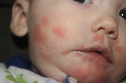Alergia pe fața copilului - ce trebuie tratat și cum arată
