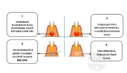 Amputarea rădăcinii dintelui, indicații, contraindicații și procedură a operației