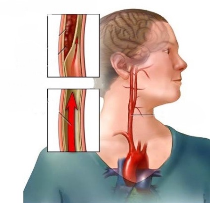 Anevrismul simptomelor, cauzelor și tratamentului arterei carotide