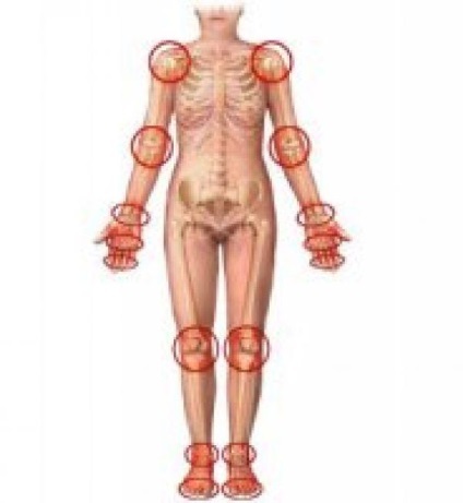Artrita articulațiilor la copii, cauze, simptome, tratament