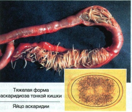 Аскариоза при децата предизвиква, симптоми и лечение