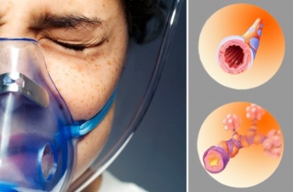 A bronchiális asztma a gyermekek tüneteiben, kezelésében és kilátásaikban az életben