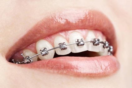 Pentru a preveni deteriorarea dinților