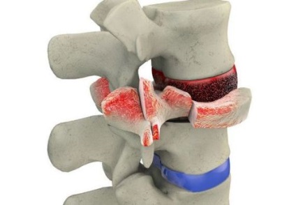 Ce este un hemangiom al coloanei vertebrale? Simptome și metode de tratament