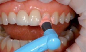 Ce reprezintă caracteristicile de curățare a dinților cu ultrasunete ale comportamentului, indicațiilor și contraindicațiilor, recenzii