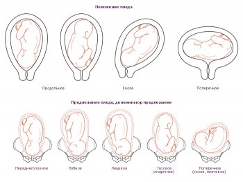 Care este prezentarea transversală a fătului în timpul sarcinii
