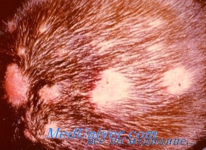 Diagnosticul diferențial al dermatofitei (ciupercii) a scalpului