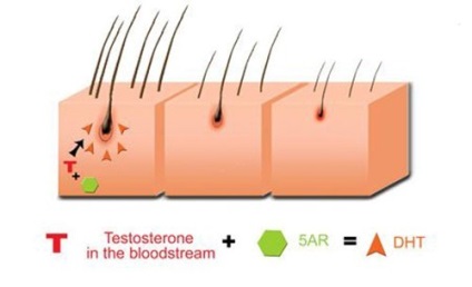 Dihidrotestosteronul și pierderea părului