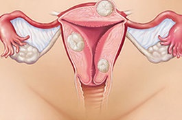 Endometrioza este misterioasă și numai la femei