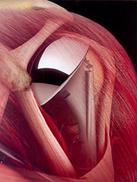 Endoproteticele articulației umărului 1