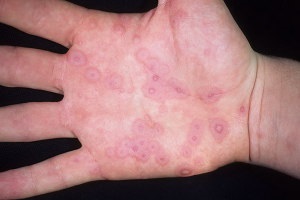 Herpesul pe mâini