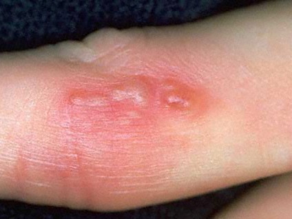 A herpesz a fényképének kezében, a megjelenés okairól és tüneteiről, valamint a kezelés módjáról