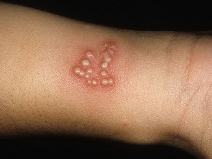 A herpesz a fényképének kezében, a megjelenés okairól és tüneteiről, valamint a kezelés módjáról
