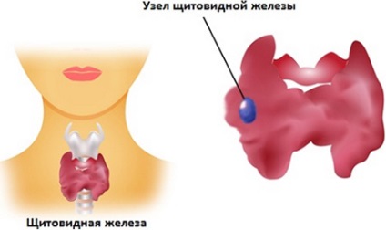 Hiperplazia tratamentului și consecințele glandei tiroide