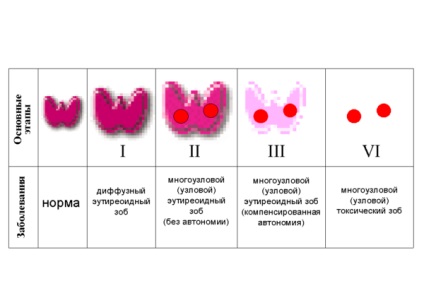 Hiperplazia tratamentului și consecințele glandei tiroide