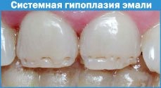Hipoplazia emaila a dinților temporari și permanenți, un sit despre stomatologia pediatrică