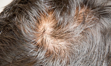Alopecia hormonala sunt cauzele, tratamentul si simptomele, centrul este k33