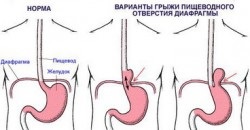 Hernia deschiderii esofagiene a diafragmei, gopod, boala de reflux gastroesofagian, gerb