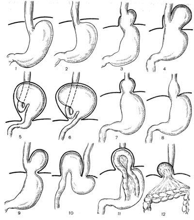 Herniile deschiderii esofagiene a diafragmei