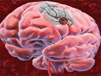 Accident vascular cerebral ischemic al creierului