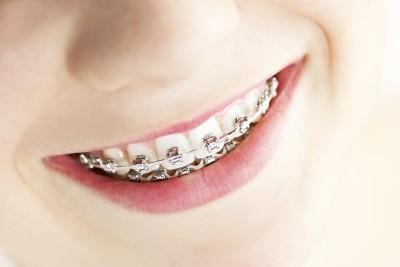 Care sunt tipurile de bretele invizibile pentru îndreptarea dinților?