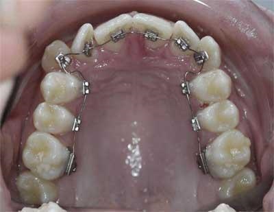 Care sunt tipurile de bretele invizibile pentru îndreptarea dinților?