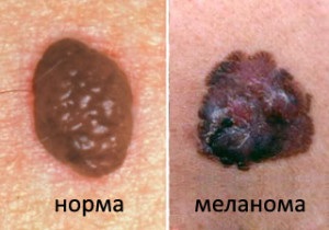 Cum arată aspectul melanomului pielii - cauze, tipuri și semne externe