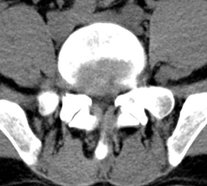 Tomografia computerizată în diagnosticul bolilor neoplazice ale coloanei vertebrale