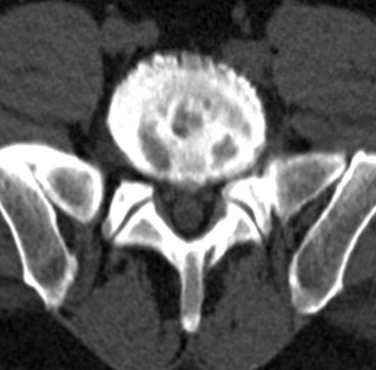 Tomografia computerizată în diagnosticul bolilor neoplazice ale coloanei vertebrale