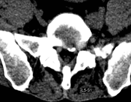 Tomografia computerizată în diagnosticul bolilor neoplazice ale coloanei vertebrale