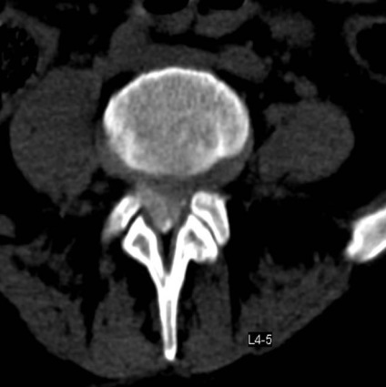 Tomografia computerizată în diagnosticul bolilor neoplazice ale coloanei vertebrale