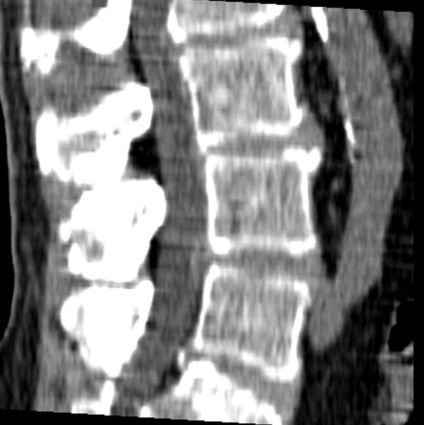 Tomografia computerizată în diagnosticul bolilor neoplazice ale coloanei vertebrale