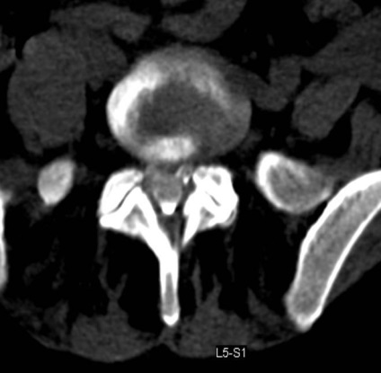 Tomografia computerizată în diagnosticul bolilor neoplazice ale coloanei vertebrale