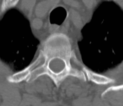 Tomografia computerizată în diagnosticul bolilor neoplazice ale coloanei vertebrale