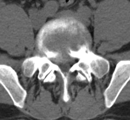 Tomografia computerizată în diagnosticul bolilor neoplazice ale coloanei vertebrale