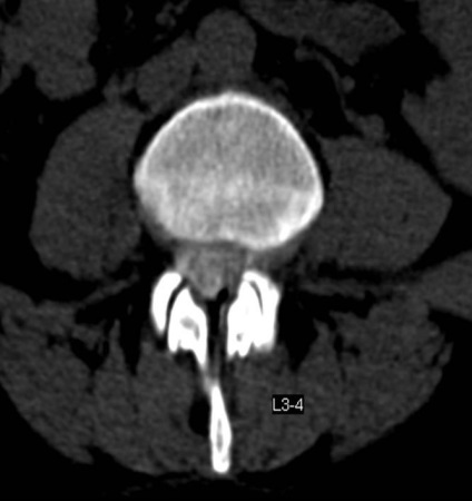 Tomografia computerizată în diagnosticul bolilor neoplazice ale coloanei vertebrale