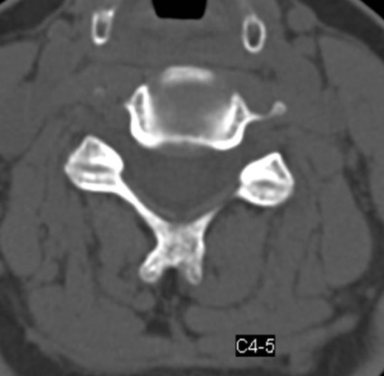 Tomografia computerizată în diagnosticul bolilor neoplazice ale coloanei vertebrale