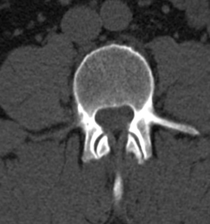 Tomografia computerizată în diagnosticul bolilor neoplazice ale coloanei vertebrale