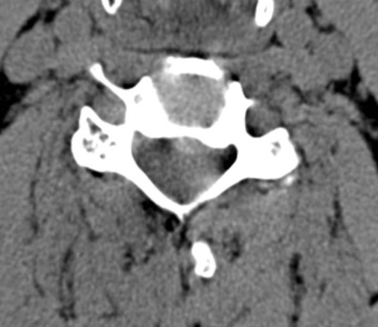 Tomografia computerizată în diagnosticul bolilor neoplazice ale coloanei vertebrale