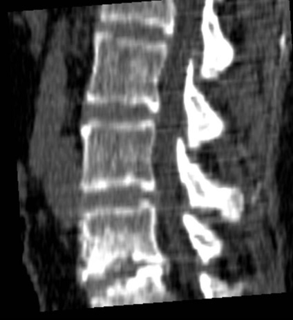 Tomografia computerizată în diagnosticul bolilor neoplazice ale coloanei vertebrale