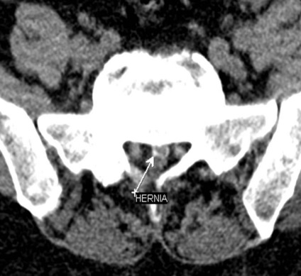 Tomografia computerizată în diagnosticul bolilor neoplazice ale coloanei vertebrale