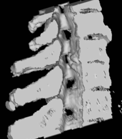 Tomografia computerizată în diagnosticul bolilor neoplazice ale coloanei vertebrale