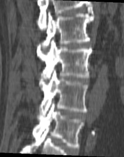 Tomografia computerizată în diagnosticul bolilor neoplazice ale coloanei vertebrale