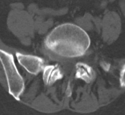 Tomografia computerizată în diagnosticul bolilor neoplazice ale coloanei vertebrale