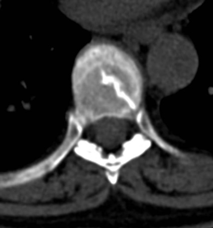 Tomografia computerizată în diagnosticul bolilor neoplazice ale coloanei vertebrale